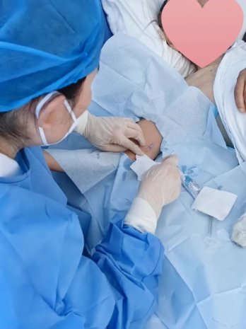 技术革新丨徐州一院静疗小组运用新技术为86岁老人解输液难题