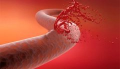 肝硬化合并上消化道大出血有救？！急诊胃镜食管内鲜血柱状喷射......