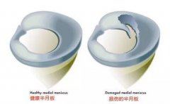 善待您的“半月板”