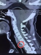 七旬老汉“囫囵吞枣”险丢性命 耳鼻喉科专家提醒春节将至“吃”要谨慎