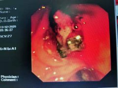 我院消化科：抗疫前线喜讯不断，后方科室同创佳绩