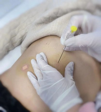 穴位埋线 不只是减肥