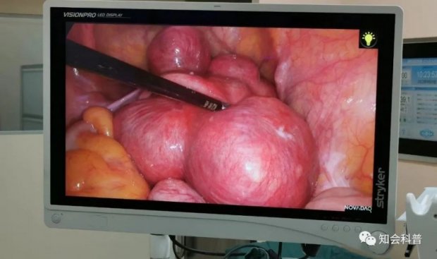 科普速递 | 聊聊子宫肌瘤