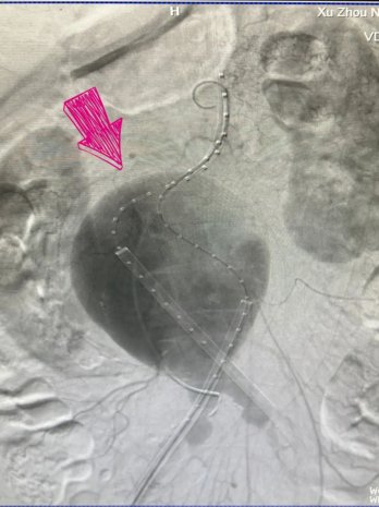 患者巨型扭曲腹主动脉瘤破裂危在旦夕 徐州一院心脏大血管外科薛松团队精准“拆弹”